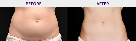 Before and After Pictures Coolsculpting